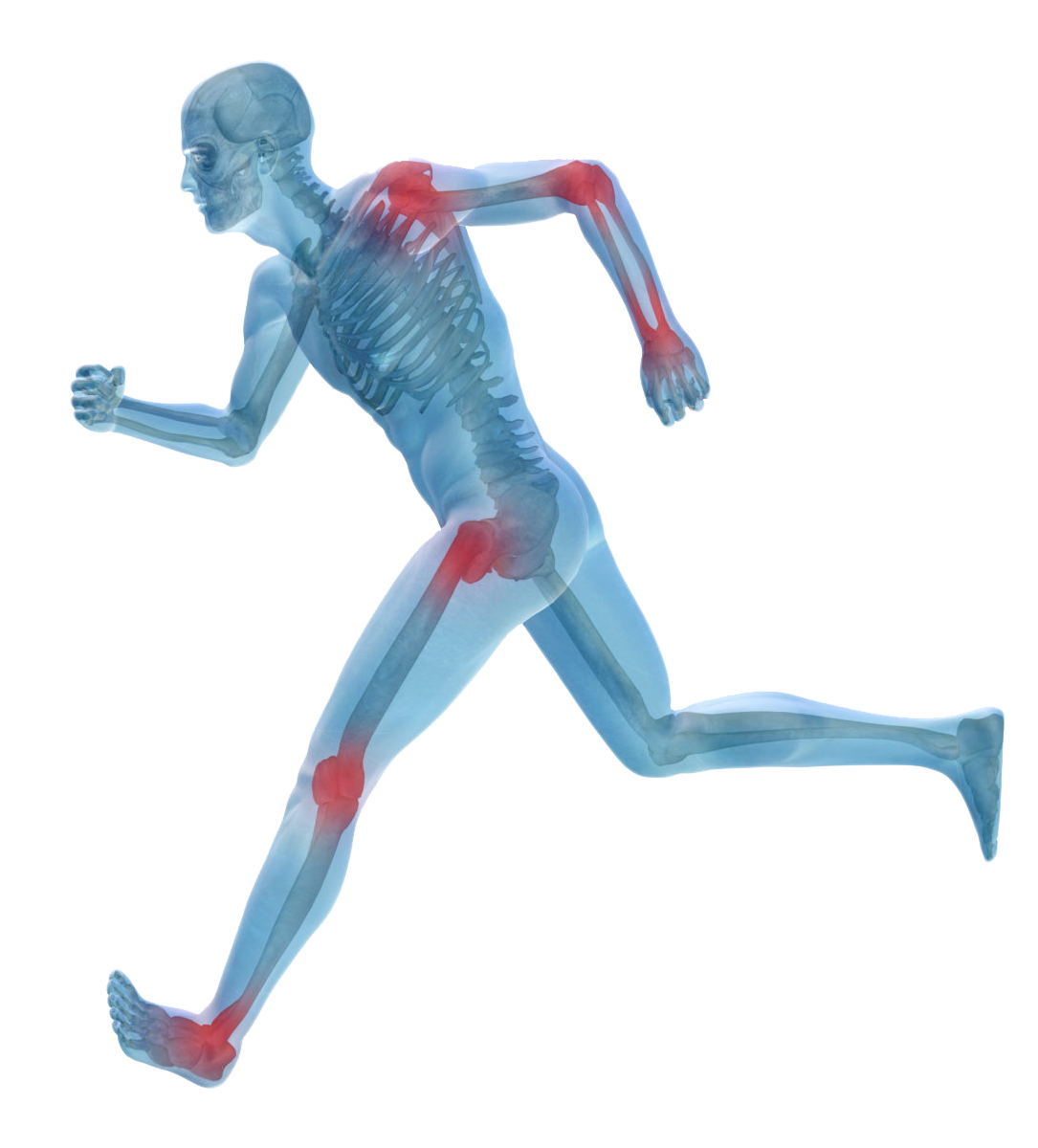 Arthritis