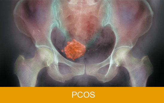 PCOS